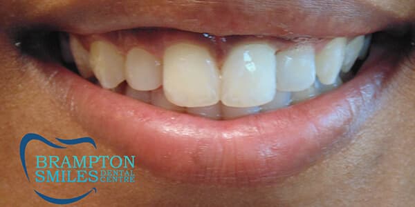 After — Before and after smile transformation at Brampton Smiles