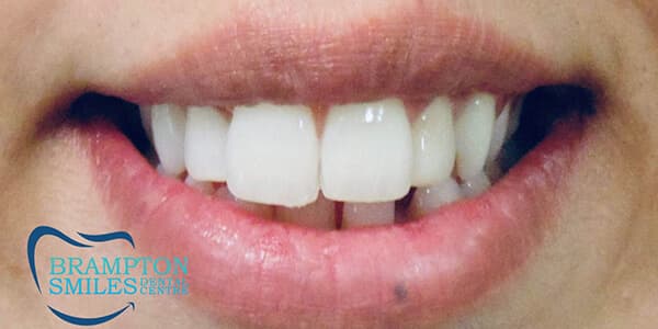 After — Before and after smile transformation at Brampton Smiles