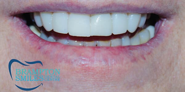 After — Before and after smile transformation at Brampton Smiles