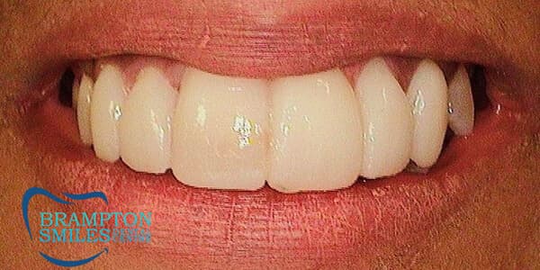 After — Before and after smile transformation at Brampton Smiles