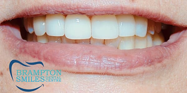 After — Before and after smile transformation at Brampton Smiles