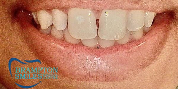 Before — Before and after smile transformation at Brampton Smiles