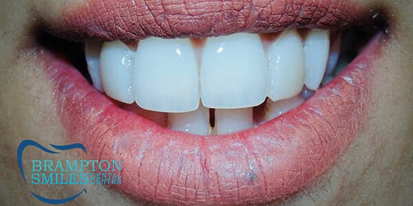 Before — Before and after smile transformation at Brampton Smiles