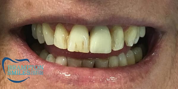 Before — Before and after smile transformation at Brampton Smiles