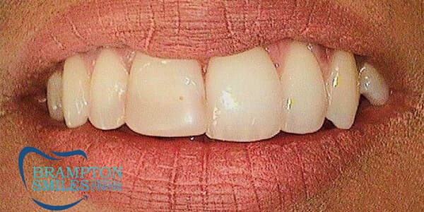 Before — Before and after smile transformation at Brampton Smiles