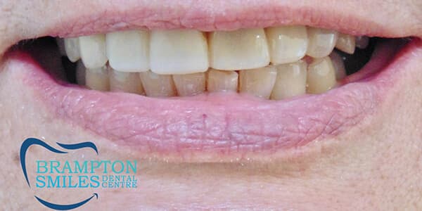 Before — Before and after smile transformation at Brampton Smiles